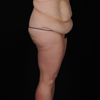 45-54 year old woman treated with SAFELipo 3126404