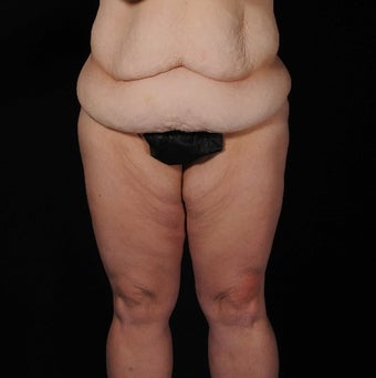 45-54 year old woman treated with SAFELipo before 3126404