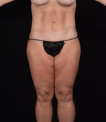 45-54 year old woman treated with SAFELipo after 3126404