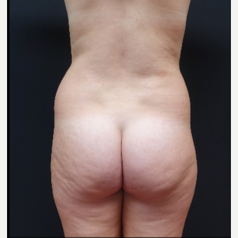 18-24 year old woman treated with Fat Transfer before 3315530