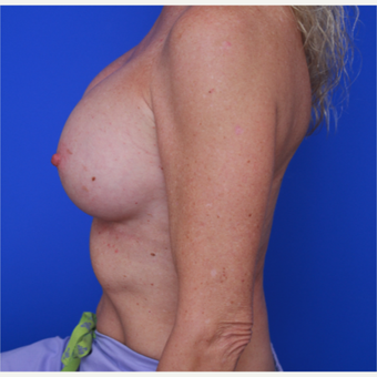 51- year old woman treated with Breast Implants after 3787640