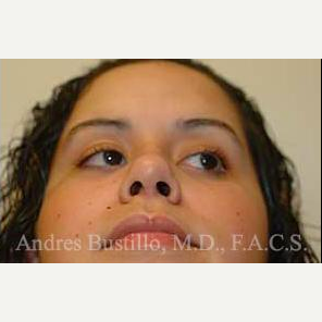 16 year old woman treated with Rhinoplasty after 3462314