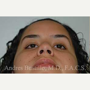 16 year old woman treated with Rhinoplasty before 3462314