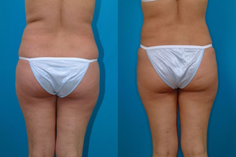 31-year-old woman treated with Liposuction. after 574518
