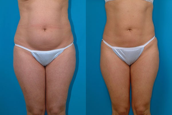 31-year-old woman treated with Liposuction. before 574518