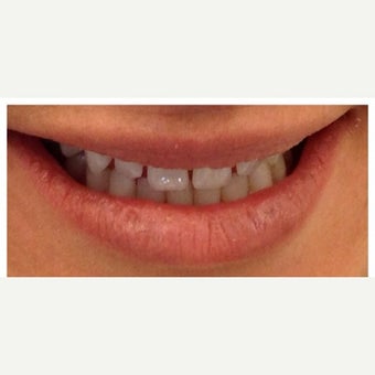 25-34 year old woman treated with Porcelain Veneers before 2449360