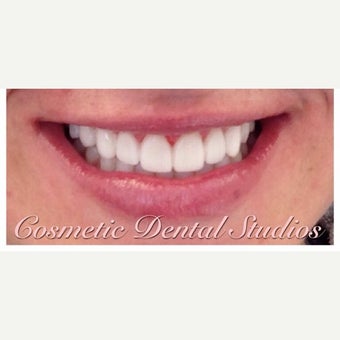 25-34 year old woman treated with Porcelain Veneers after 2449360