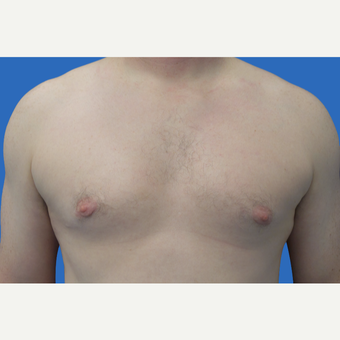 35 year old patient, unhappy with his chest after 3147084