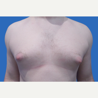 35 year old patient, unhappy with his chest before 3147084