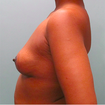 33 year old woman treated with Breast Lift after 3467384