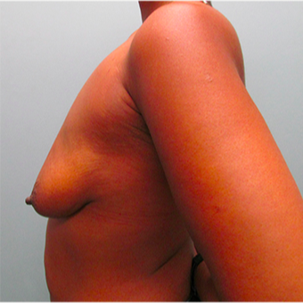 33 year old woman treated with Breast Lift before 3467384