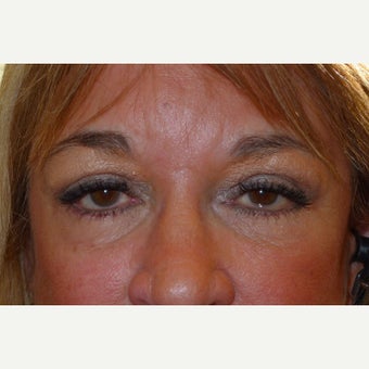 55-64 year old woman treated with Forehead Lift after 2593275