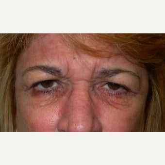 55-64 year old woman treated with Forehead Lift before 2593275