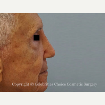 75 and up year old man treated with Revision Rhinoplasty after 3198220