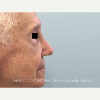 75 and up year old man treated with Revision Rhinoplasty before 3198220