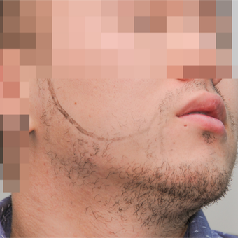 25-34 year old man treated with ARTAS Robotic Hair Transplant before 3300412