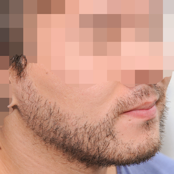 25-34 year old man treated with ARTAS Robotic Hair Transplant after 3300412