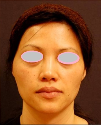 Fat Transfer for Cheek Augmentation before 555878