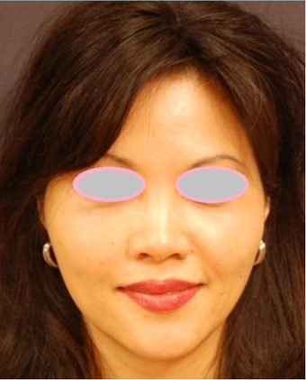 Fat Transfer for Cheek Augmentation after 555878