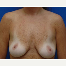 35-44 year old woman treated with Breast Lift with Implants before 3423777