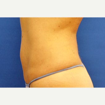 35-44 year old woman treated with Smart Lipo after 3770097