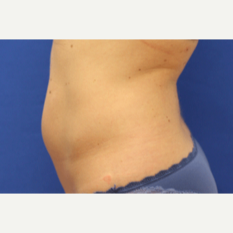 35-44 year old woman treated with Smart Lipo before 3770097