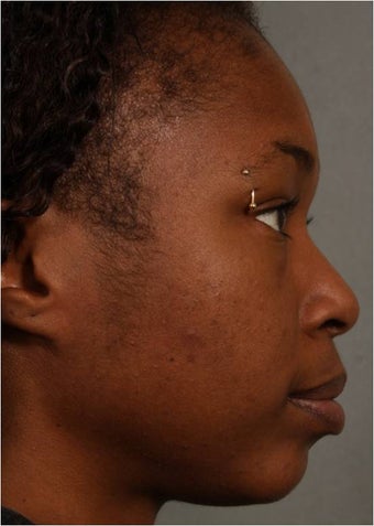 31 year old african american female with weak chin would like non surgical treatment after 798471