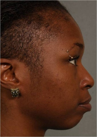31 year old african american female with weak chin would like non surgical treatment before 798471