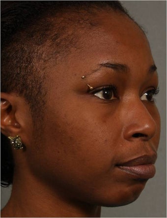 31 year old african american female with weak chin would like non surgical treatment 798471