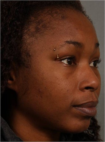 31 year old african american female with weak chin would like non surgical treatment 798471