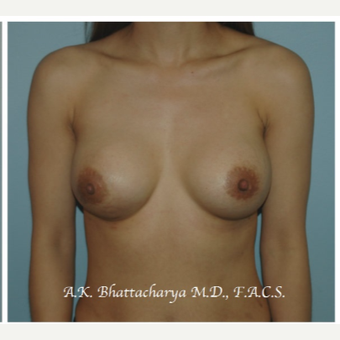 25-34 year old woman treated with Breast Augmentation after 3610314