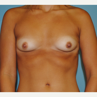 25-34 year old woman treated with Breast Implants before 3071133