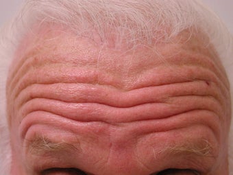 Forehead Lift before 1007743