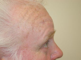 Forehead Lift 1007743