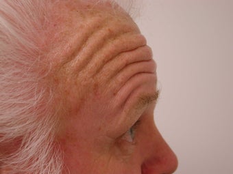 Forehead Lift 1007743