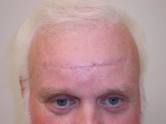 Forehead Lift after 1007743