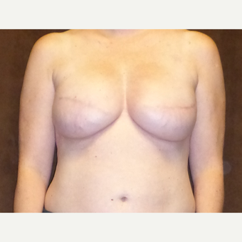 45-54 year old woman treated with Breast Reconstruction after 3616097