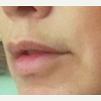 35-44 year old woman treated with Lip Lift before 3043312
