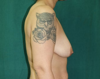 25-34 year old woman treated with Breast Augmentation 3659702