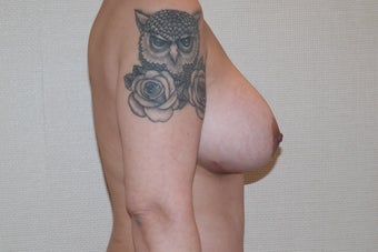 25-34 year old woman treated with Breast Augmentation 3659702