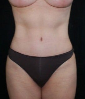 Tummy Tuck after 1632187