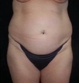 Tummy Tuck before 1632187