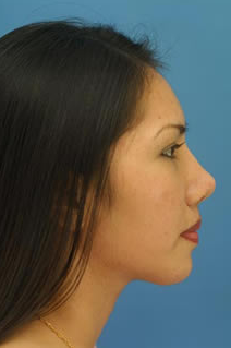 Ethnic Rhinoplasty after 1109787