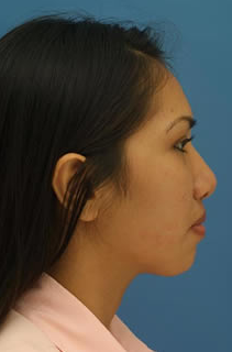 Ethnic Rhinoplasty before 1109787
