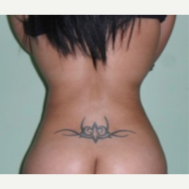 35-44 year old woman treated with Slim Lipo after 3002001
