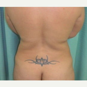 35-44 year old woman treated with Slim Lipo before 3002001