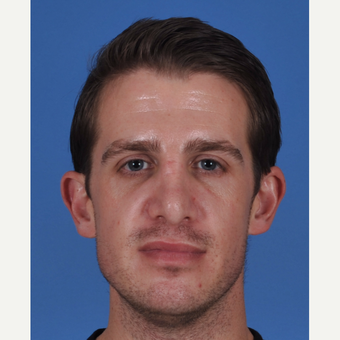 25-34 year old man treated with Revision Rhinoplasty before 3434419