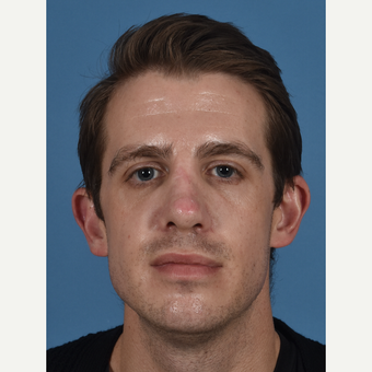 25-34 year old man treated with Revision Rhinoplasty after 3434419