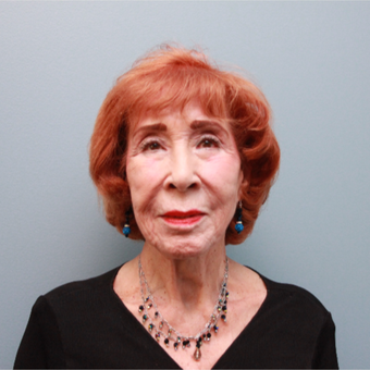 83 year old treated with a Neck Lift, Lower Face Lift and Fat Transfer before 3544556