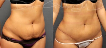 Tummy Tuck With Liposuction after 1733338
